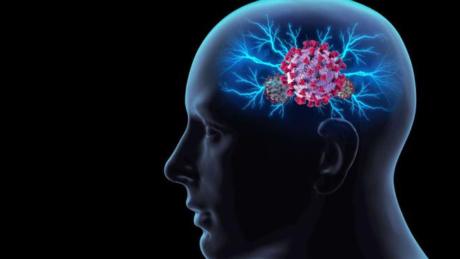 Alzheimer : un risque augmenté de 50 à 80% après une infection au SARS-CoV-2 pour les personnes âgées