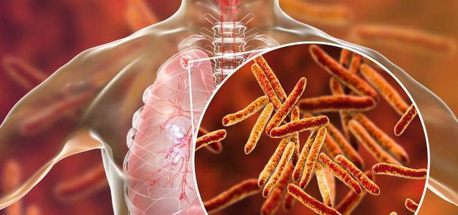 Hausse des cas de tuberculose  suite à la pandémie de Covid-19