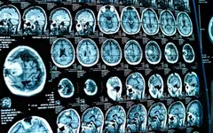 COVID-19 : des analyses par IRM montrent un vieillissement précoce du cerveau chez les adolescents