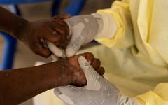 Épidémie de mpox : l'agence de santé de l'Union africaine déclenche son plus haut niveau d’alerte