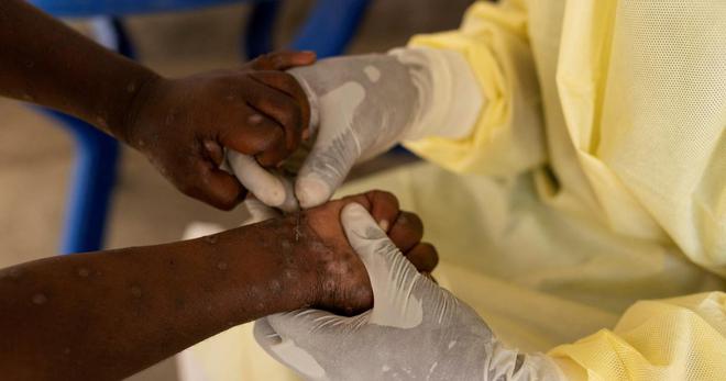 Épidémie de mpox : l'agence de santé de l'Union africaine déclenche son plus haut niveau d’alerte